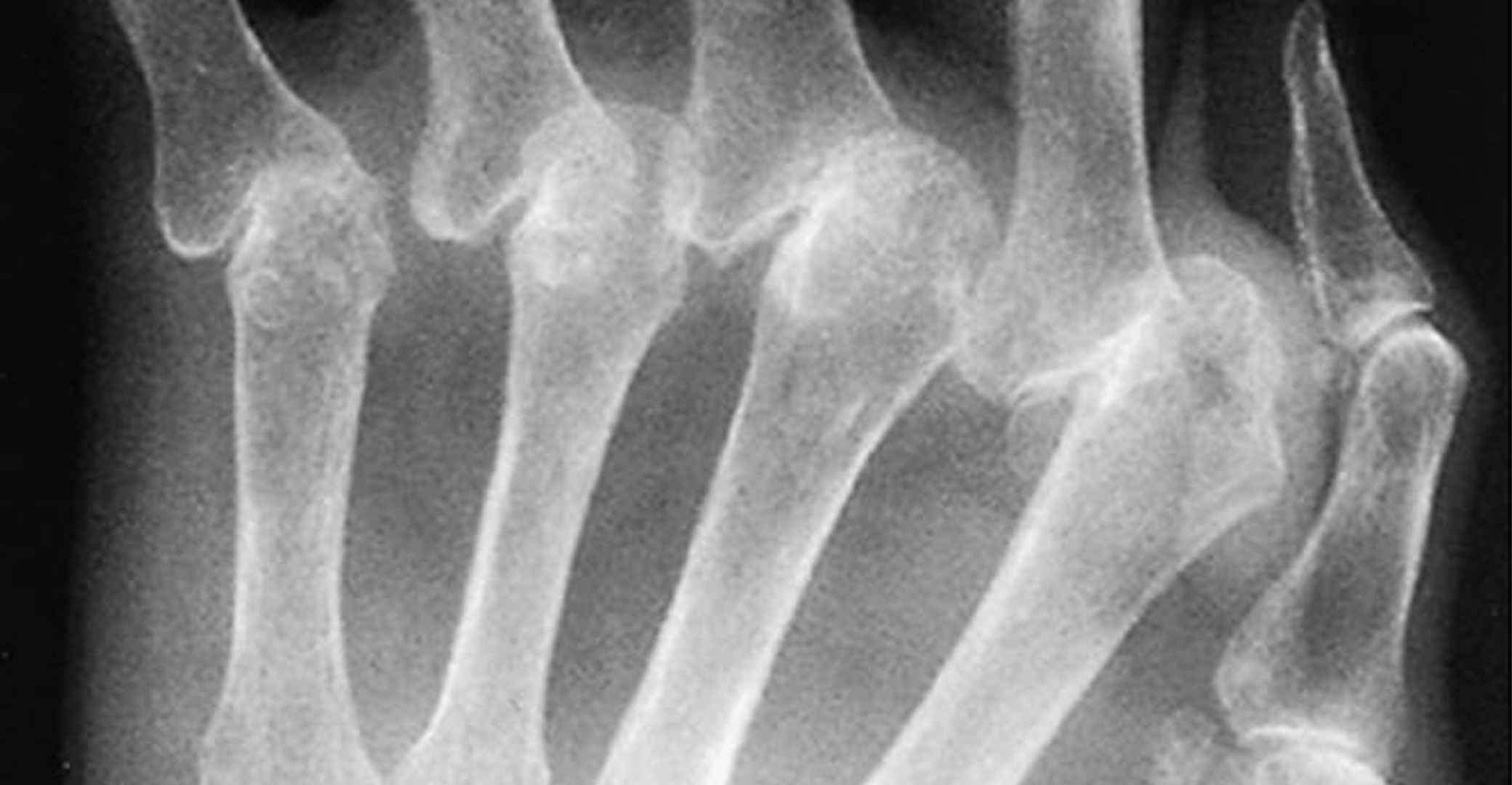 Rheumatoid Arthritis